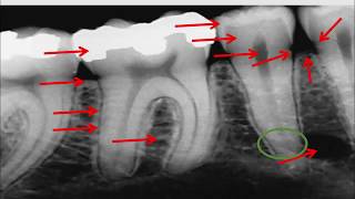 Radiographie rétro  alvéolaire [upl. by Eelarual]