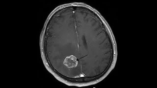 🥇 ANATOMÍA DEL CEREBRO 12 Telencéfalo ¡Explicación Sencilla [upl. by Eeldarb687]