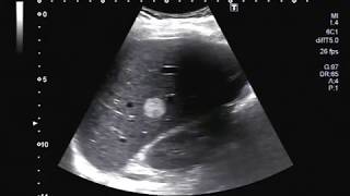 Ultrasound Video showing hemangioma in Liver [upl. by Eadahc]