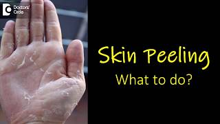 What causes skin peeling from fingers and feet How to manage  Dr Rasya Dixit [upl. by Ellehcan750]