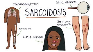 Understanding Sarcoidosis A Visual Guide for Students [upl. by Latsyrhk131]