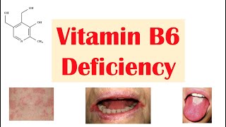 Vitamin B6 Pyridoxine Deficiency  Dietary Sources Causes Signs amp Symptoms Diagnosis Treatment [upl. by Manfred]