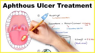 Aphthous ulcer stomatitis Canker sore treatment [upl. by Winther404]