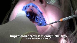 Dental Implant  Impression and Insertion of crown [upl. by Camille]