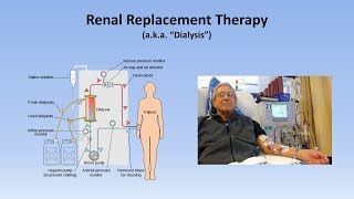 Acute Kidney Injury Part 33  Treatment and Complications [upl. by Koffler]