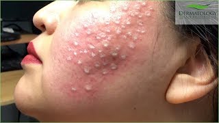 Acne Scar Treatment TCA Cross using TCA 80 [upl. by Ynaffi362]