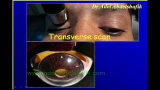 Ophthalmology Lecture  Tropias amp Phorias part 22 [upl. by Ruttger]