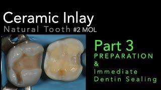 Lithium Disilicate Ceramics Part 3 Preparation and Immediate Dentin Sealing IDS [upl. by Ihcekn743]