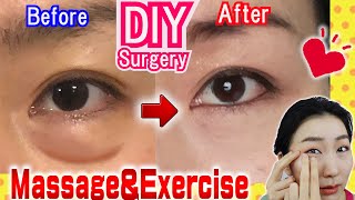 How to Remove Under Eye Bags👁️ Naturally in 7 Days Massage amp Exercises🙋 [upl. by Aisitel737]