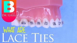 Lace Ties for Braces [upl. by Sabella]