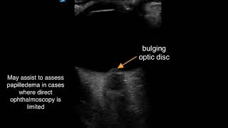 POCUS to Identify Papilledema [upl. by Tnafni]