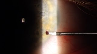 Corneal Foreign Body Removal [upl. by Ellenuahs967]