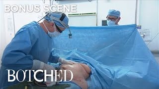 quotBotchedquot Doc Performs Liposuction Surgery  E [upl. by Hort]