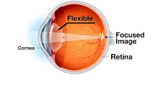 Mayo Clinic Minute Blurry vision as you age [upl. by Ateekan181]