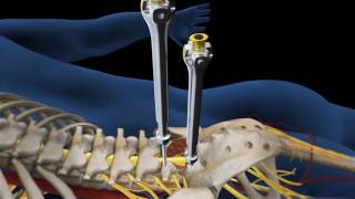 Lumbar Fusion of L5 S1 Animation [upl. by Ingemar]