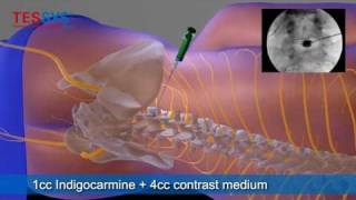 Treatment of herniated disc with TESSYS method lateral  BandscheibenOP mit TESSYSMethode lateral [upl. by Rayner]