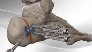 Flatfoot Repair with Arthrex® Calcaneus Step Plate [upl. by Riek]