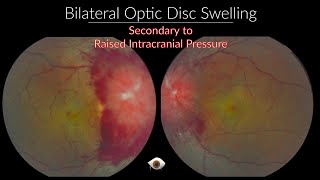 Papilloedema  Optic Nerve swelling [upl. by Herbert]