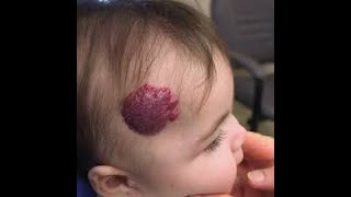 WHAT IS HEMANGIOMA Causes Treatment Baby  Cherry Hemangioma Infantile Strawberry Hemangioma [upl. by Humpage]