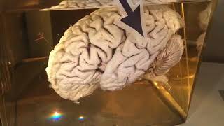 Einsteins brain A trip to the Mutter Museum in Philadelphia [upl. by Htir]