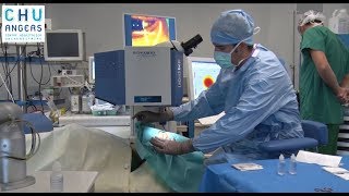 La chirurgie au laser en ophtalmologie du CHU Angers [upl. by Christy]