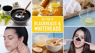 Easy Ways To Remove Blackheads And Whiteheads At Home [upl. by Puduns104]