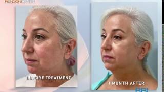 Liposuction  Before And After  Dr Timothy Alexander  South Florida Center for Cosmetic Surgery [upl. by Nyrak]