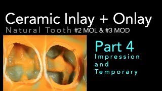 Lithium Disilicate Ceramics Part 4 Impression and Temporary [upl. by Nosila]