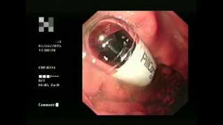 Capsule Endoscopy a helping hand [upl. by Nnovahs]