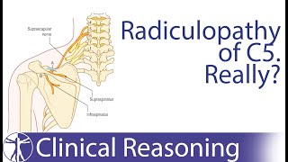 Suprascapular Nerve Entrapment mimicking C5 Radiculopathy [upl. by Marnie]