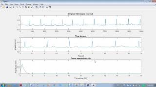 Signal Processing Matlab  How to import raw ECG data from Physionet database [upl. by Eniarda]