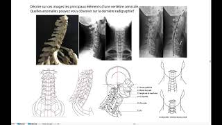 Radiographies du rachis cervical [upl. by Crissie466]