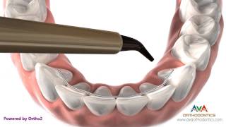 Orthodontics Retainer  Bonded or Permanent [upl. by Notsniw229]