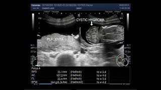 Zika confirmed as a cause of microcephaly [upl. by Hairakcaz]