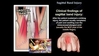 Sagittal Band Injury  Everything You Need To Know  Dr Nabil Ebraheim [upl. by Enreval]