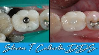 Securing Loose Implant Crown  Dental Minute with Steven T Cutbirth DDS [upl. by Anil943]