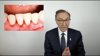 How to Treat Bleeding Gums at Home [upl. by Animsay53]