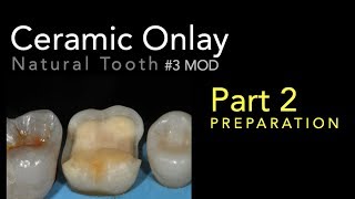 Lithium Disilicate Ceramics Part 2 Ceramic Onlay Preparation [upl. by Ugo]