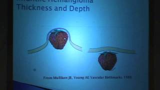 Laser Treatment for Hemangiomas Sorting Through the Myths [upl. by Suckram]