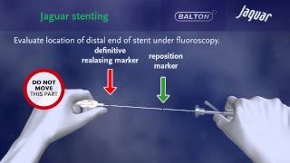 SELFEXPANDING NITINOL STENT quotJAGUARquot with delivery system [upl. by Karab]