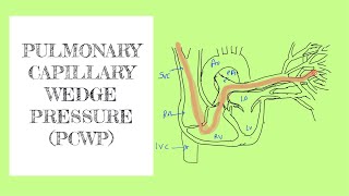 Pulmonary capillary wedge pressure PCWP [upl. by Nemrac]