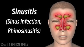 Sinusitis Animation [upl. by Yekcor]