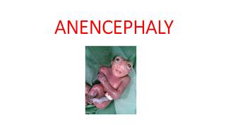 ANENCEPHALY [upl. by Hanover663]