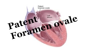 Whats Patent Foramen Ovale PFO Pediatrics [upl. by Okire]